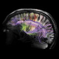 Photo courtesy of Van J. Wedeen, MD, and Lawrence L. Wald, PhD, Athinoula A. Martinos Center for Biomedical Imaging
