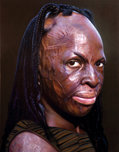 WITH HONOR: Doug Auld painted Shayla in 2005, nine years after fire had covered most of her then five-year-old body with severe burns.  Although her injuries deprived her of her fingers, she succeeded in learning to play the piano. She also excelled academically while in high school, becoming an honor student and  class president. 