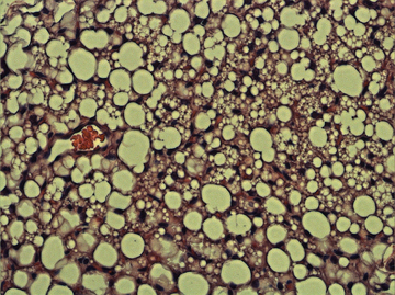 Wasting subcutaneous fat mixed with normal/single-fat-droplet-containing cells and browning/multiple-fat-droplet-containing cells. Image: Spiegelman lab