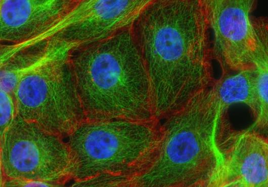 Stress fibers and microtubules in human breast cancer. Vivid blue clusters surrounded by green and red filaments