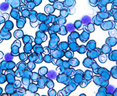 Leukemia cells 