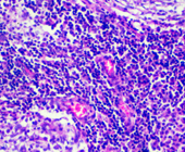 tuberculosis under microscope
