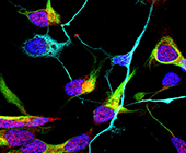 neural cells from Alzheimer's patients