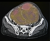 ovarian cancer