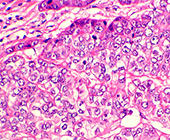 triple-negative breast cancer cells under a microscope