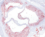 sleep fragmentation of atherosclerosis