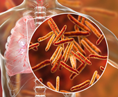 secondary tb in lunch and close-up of tb bacteria