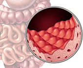 damaged villi from celiac disease