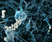neurons with amyloid plaques