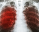 xray of pulmonary TB