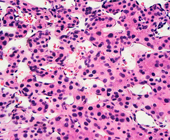 hepatocellular carcinoma