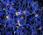 Illustration of Alzheimer's plaque