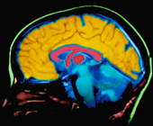 image of a brain with different colors highlighting areas