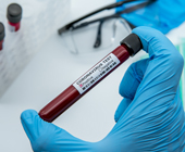 photo of hand with medical glove holding vial of blood