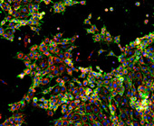 Cells from a mouse model of breast cancer cancer cells imaged for signals of cell death after a brief exposure to anti-cancer drugs.