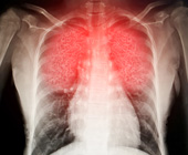 xray image of lung with red area