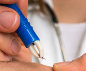 Doc extracting a tick with tweezers 