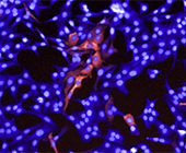 melanoma cells