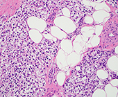 Clear bubble-like cells appear amid smaller pink-stained cells on a histology slide