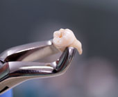 Dentist clamp holding an extracted tooth
