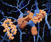 Digital illustration of yellow amyloid plaques on blue neurons with black background