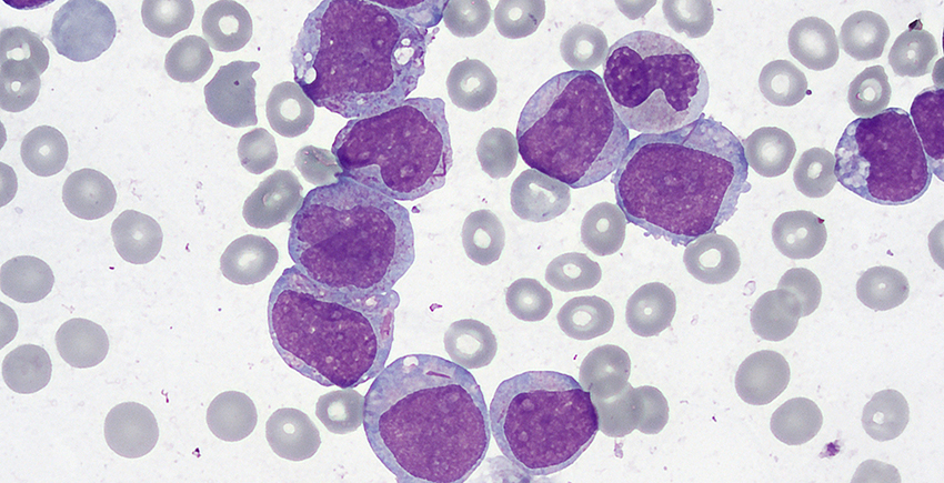 healthy cells shown in gray while cancerous cells are large and stained purple