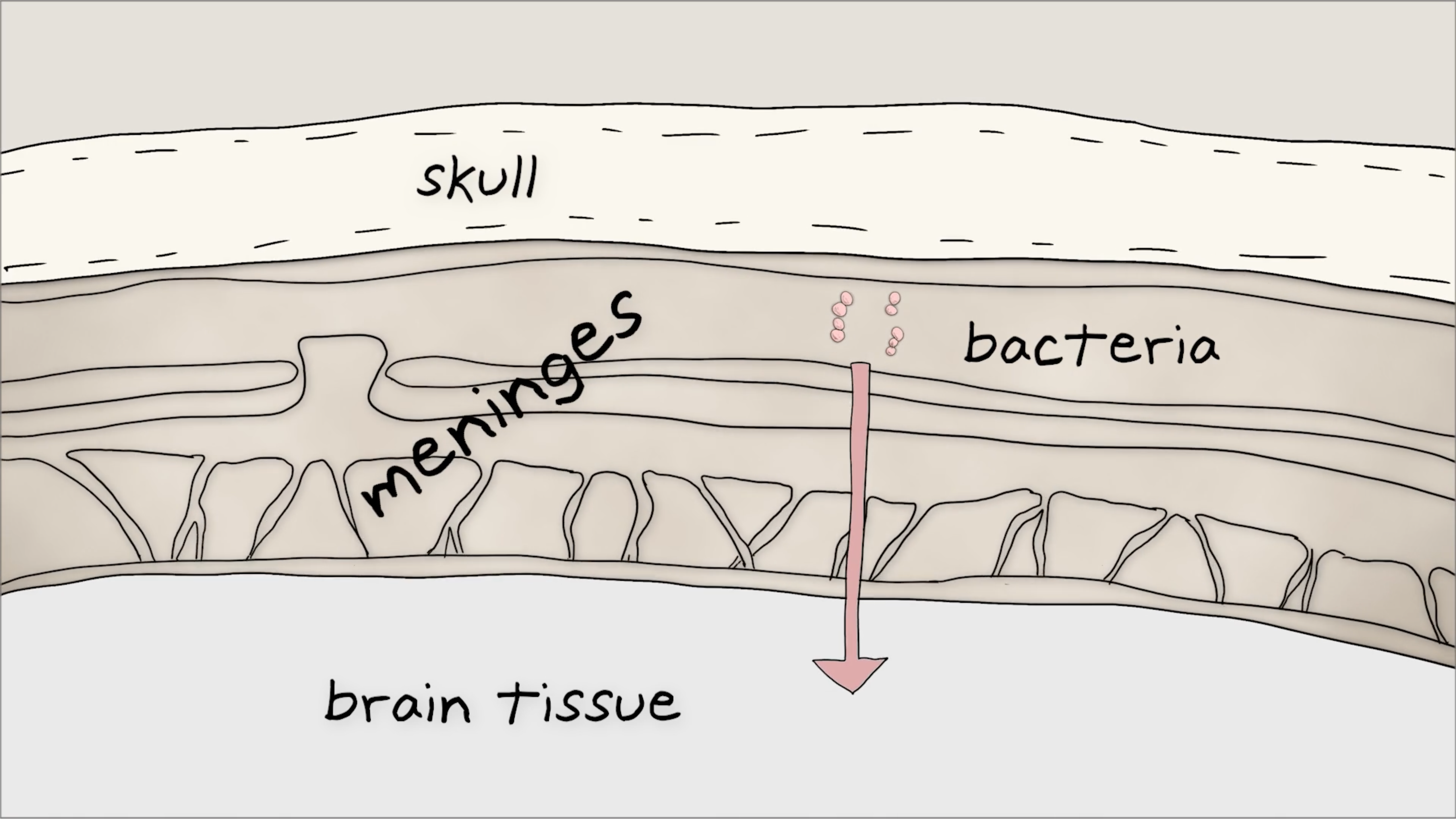 illustration of a cross-section of the skull, with layers labeled "skull" (top), "meninges" (middle), and "brain tissue" (bottom). dots labeled "bacteria" are shown moving from the meninges into the brain with a directional arrow