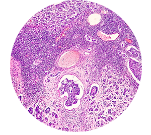 Photomicrograph of a breast core biopsy