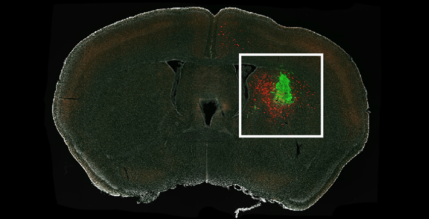 Cross-section of a mouse brain under a microscope shows a cluster of glioma cells tagged in green and connected neurons shown in red, concentrated around the glioma but also stretching from other areas of the brain.