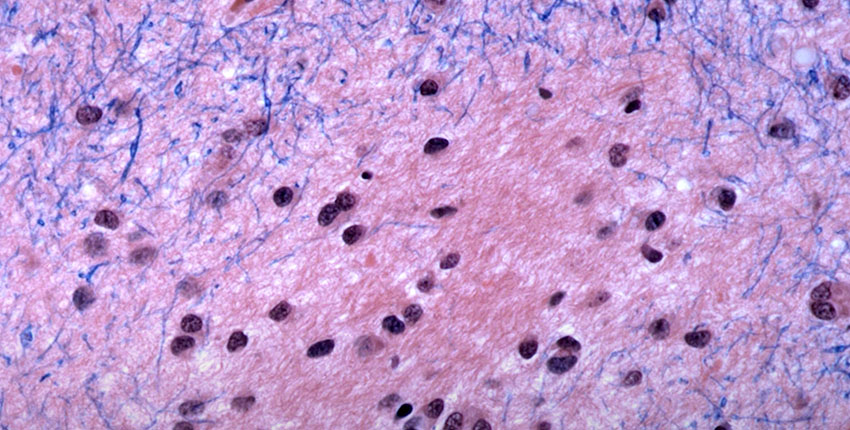 Brain tissue in Huntington’s disease