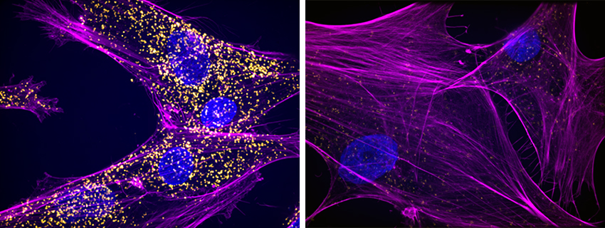 Two side-by-side views of cells under a microscope have sweeping lines and 2-4 round nuclei. The one on the left also contains hundreds of tiny yellow dots, whereas the one on the right has only a few.