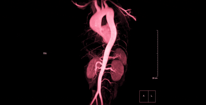 A rotating image of a red aorta against a black background.