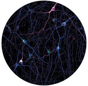 THIS CONFOCAL IMAGE SHOWS  STEM-CELL-DERIVED INEURONS  LABELED FOR PHOSPHORYLATED  α-SYNUCLEIN, A PROTEIN LINKED TO  PARKINSON’S DISEASE, SPECIFICALLY  AT THE SERINE 129 SITE (PHSYN129,  MAGENTA); AN ENDOSOMAL  MARKER (EEA1, GREEN); AND THE  CYTOSKELETON (TUBULIN, BLUE).