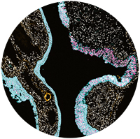 An early ovarian precancer