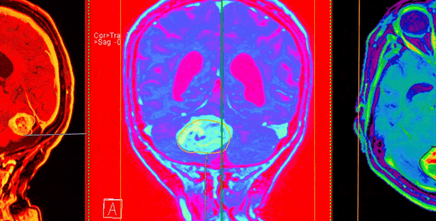 Three vibrantly colored views of a brain MRI showing a large tumor