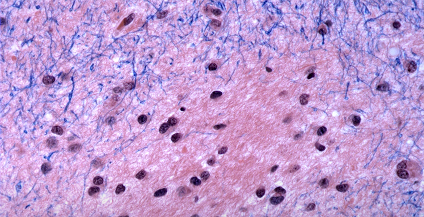 Brain tissue in Huntington’s disease