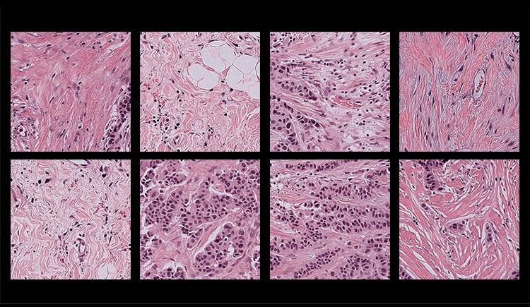 Researchers Discover Bias in AI Models That Analyze Pathology Samples | Harvard Medical School