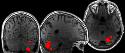 Three views of a gray brain scan with bright red spots on a black background 