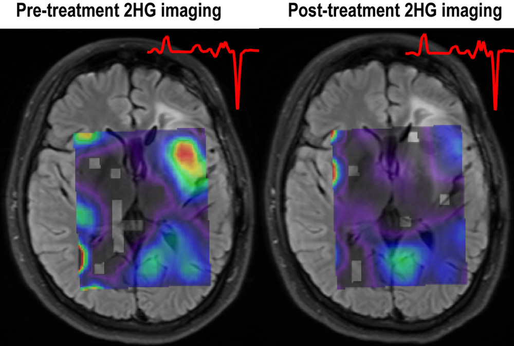 New View of Gliomas