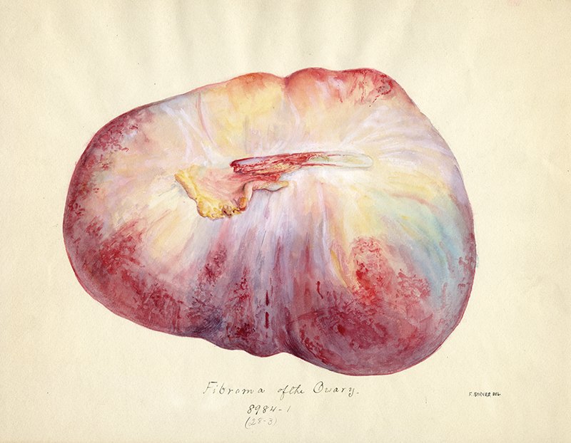 colored drawing of an ovarian fibroma