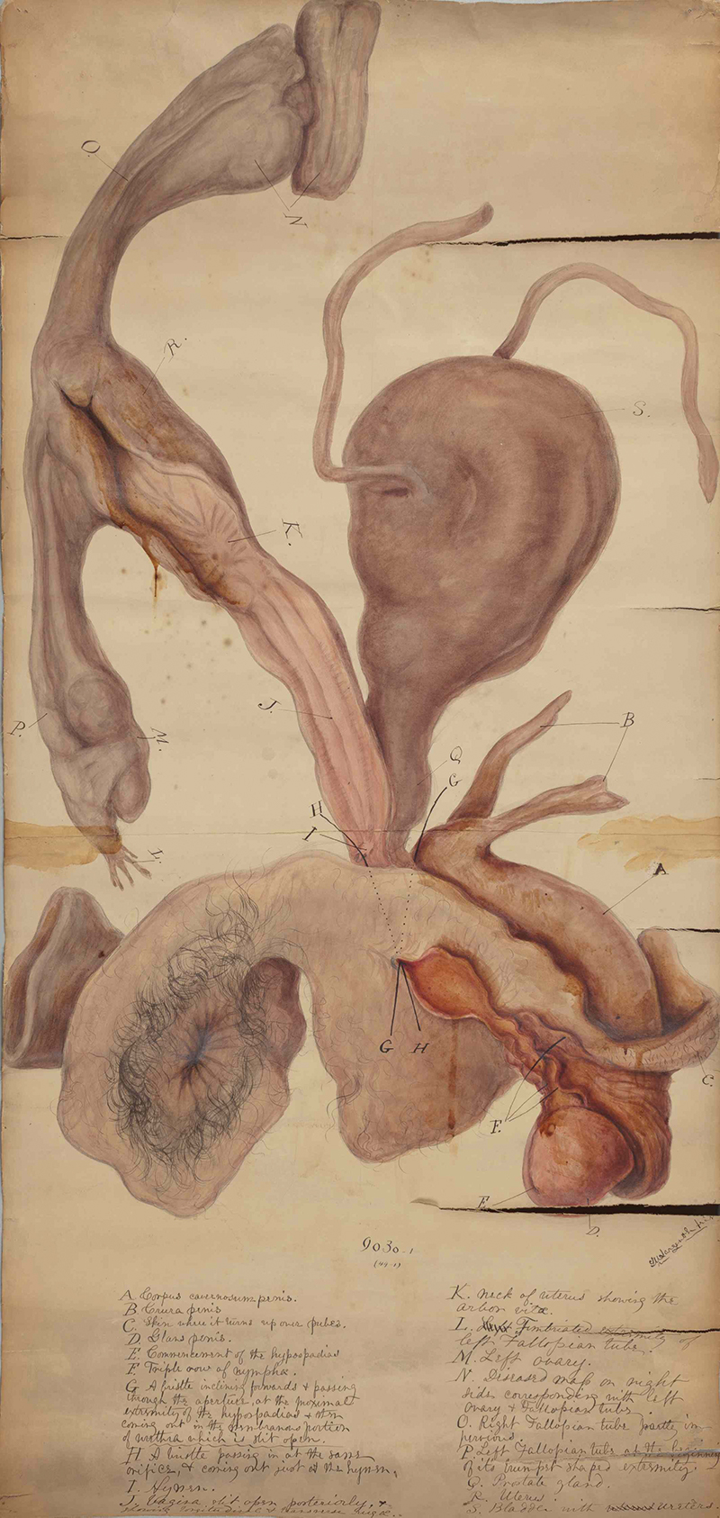 watercolor, circa 1800, of urogenital system of patient Thomas M
