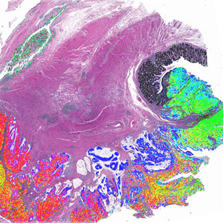 Multicolored patches representing features of colorectal cancer