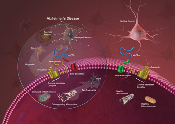 Characteristics of Alzheimer’s disease. Image: National Institute on Aging
