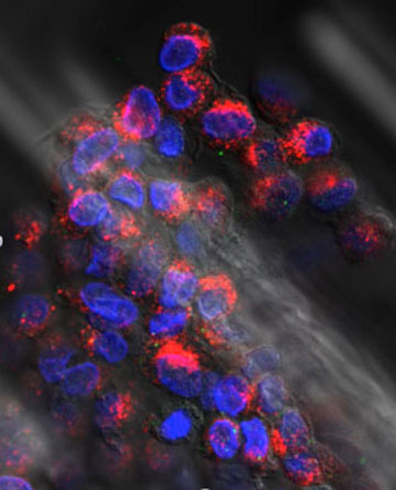 In a cluster of circulating tumor cells from a breast cancer patient, some cells have transitioned from an epithelial cell type, indicated by small green markers, to a mesenchymal type (red), believed to be more likely to cause metastasis. Image courtesy of Min Yu, Mass General Cancer Center.