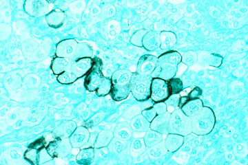 Reduced levels of a protein that controls glucose metabolism and tumor suppression were found in tumor samples from patients with pancreatic or colorectal cancer. An example of pancreatic cancer cells (not part of the study). Lance Liotta Lab Photo/National Cancer Institute.