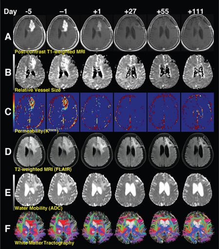 A tumor’s retreat. Images from the best-responding patient show the potential effects of an angiogenesis inhibitor on glioblastoma. Numbers at the top correspond to days before or after starting treatment. Row A shows the tumor, in white, shrinking over time. Row B indicates the relative size of small blood vessels in the brain, which also shrink. Row C shows the permeability of the glioblastoma blood vessels, which drops from the first dose. Rows D and E depict edema diminishing in regions around the tumor. And row F reveals tracts of white matter in the central part of the brain becoming more visible around the tumor as edema subsides. Image courtesy of Dan Duda.