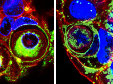 No exit. After invading its neighbor, a cancerous MCF7 cell is attacked by a large lysosome (marked by a green ring) inside its host. Non-cancerous MCF10A cells (right) display the same behavior. This MCF10A cell contains two other cells in large lysosomal compartments. Courtesy of Michael Overholtzer.