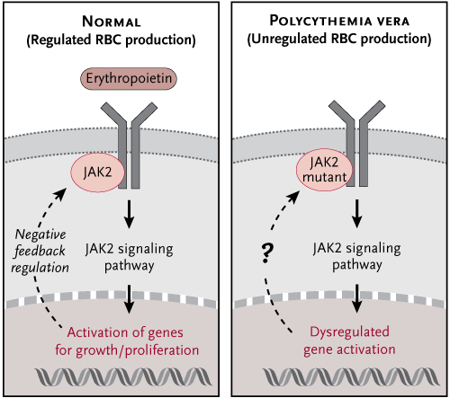 Mechanism of disease. Polycythemia vera (PV) causes dysregulated red blood cell (RBC) production in the bone marrow. In normal red blood cells (left), a kinase protein, JAK2, is activated following binding of the growth hormone erythropoietin. JAK2 then activates a signaling pathway that instructs red blood cells to replicate; the process is strictly regulated by various feedback pathways. In PV (right), the presence of a mutant version of JAK2 results in dysregulated downstream signaling in the absence of erythropoietin. Illustration by Rachel Eastwood.