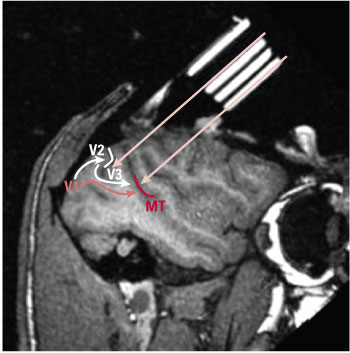 This MRI scan of a monkey brain (with white eye socket to the right) shows the visual cortex and areas V1, V2, V3, and MT. The arrows depict the approximate tracks of recording electrodes. The indirect neuronal pathway inactivated in this study is indicated by the white arrows between V1 and MT that pass through V2 and V3. The direct pathway is indicated in pink and was left intact. Courtesy Richard Born.