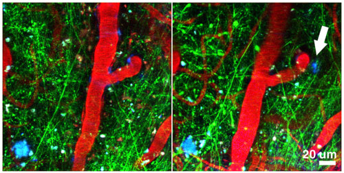 Breaking down plaque build-up. With the aid of a novel microphoton imaging technique, amyloid plaques (blue) can be seen along neurites (green) and blood vessels (red). The arrow in the right image indicates a plaque that is newly formed. Courtesy Melanie Meyer-Luehmann 